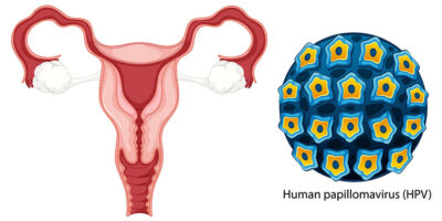 Papillomavirus umano (HPV)