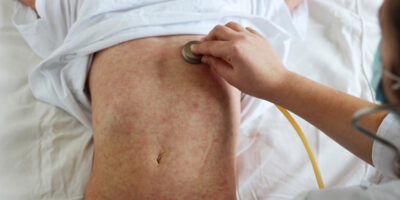 Morbillo, Parotite, Rosolia e Varicella