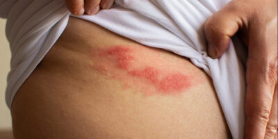 Herpes zoster