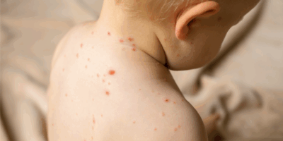 Morbillo 2025: il ritorno del virus in Italia e le nuove strategie di contenimento